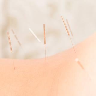 acupuncture-1290x1290